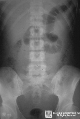 Localized ileus-LUQ